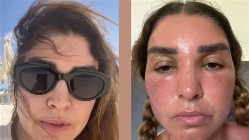 روجينا تكشف تفاصيل إصابتها بحرق في وجهها بسبب الشمس