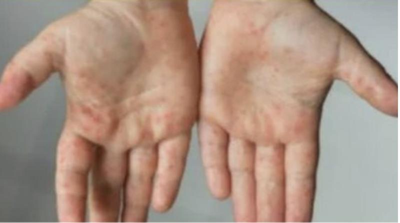 «تحذيرات لطلاب المدارس».. استشاري مناعة تكشف 5 أعراض لفيروس HFMD