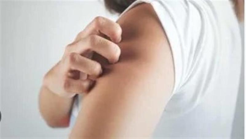 مع دخول الشتاء.. خبير جلدية توضح أسباب زيادة أعراض الصدفية وطرق مواجهتها مع دخول الشتاء.. خبير جلدية توضح أسباب زيادة أعراض الصدفية وطرق مواجهتها